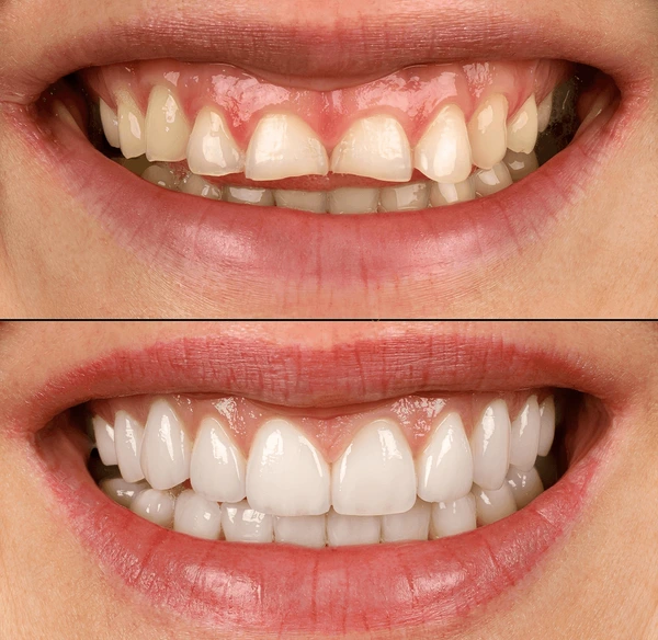 Before & After